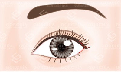 開眼尾手術-Y型切割線設計